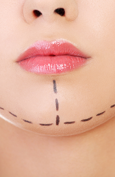 Juvederm Ultra XC and Ultra Plus XC